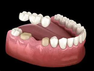 Dentures & Bridges